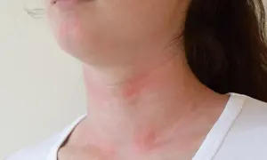 Uczulenie na curry objawy - jak je rozpoznać i uniknąć reakcji alergicznych
