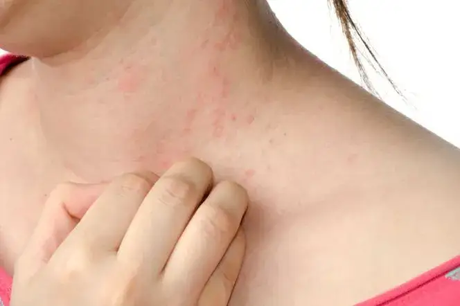 Zdjęcie Uczulenie na curry objawy - jak je rozpoznać i uniknąć reakcji alergicznych